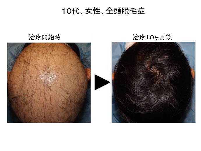 円形脱毛症　病院""
